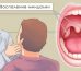 Как избавиться от гнойных пробок в горле, их причины